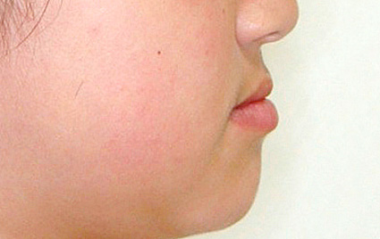 下顎前突（かがくぜんとつ／受け口）　治療前　側面（顔）