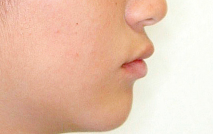 下顎前突（かがくぜんとつ／受け口）　治療後　側面（顔）