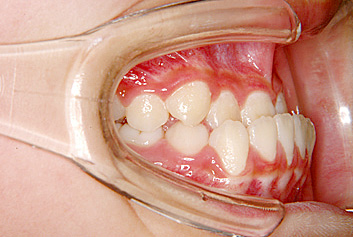 下顎前突（かがくぜんとつ／受け口）　治療前　側面（歯）