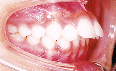 上顎前突（じょうがくぜんとつ／出っ歯）　治療前　側面（歯）