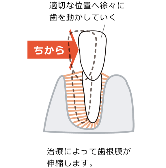 歯が動く仕組み02　治療によって歯根膜が伸縮します。